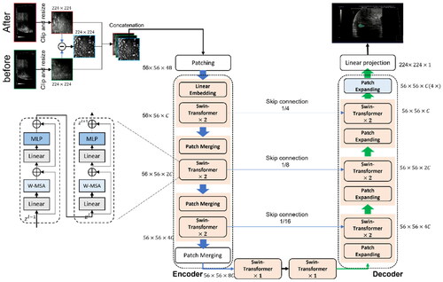 Figure 4. AI algorithm used in conjunction with US imaging. B-mode images captured before and after FUS treatment undergo a preprocessing stage, in which they are Clipped to a predefined surgical region based on prior knowledge. These images are then resized to 224 × 224 grayscale resolutions. Subsequently, the images and their pixel-wise difference are concatenated to generate a three-channel image. This image serves as the input for the Swin-Unet model, which produces the segmented region of the FUS ablation as its output.