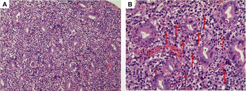 Figure 3 HE staining showing a large number of plasma cells and a small amount of neutrophil infiltration in the intrinsic mucosa. (A) Low magnification (original magnification ×100); (B) high magnification (original magnification ×400) (Red arrows: plasma cells).