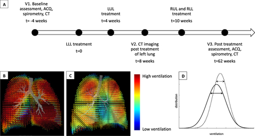 Figure 1 Timeline and methodology. (A) Timeline for treatment and assessment. (B–C) Functional respiratory imaging derived regional ventilation map showing (B) homogeneous ventilation in a healthy subject, and (C) ventilation heterogeneity in a subject with severe asthma. (D) Schematic representation of expected changes in the ventilation histogram before (solid line) and after (dotted line) BT. The diagram illustrates a reduction in spread or standard deviation in the post-BT histogram, signifying a reduction in ventilation heterogeneity after BT.
