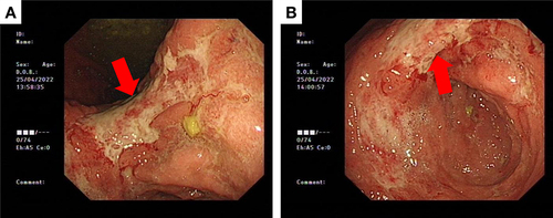Figure 2 Gastroscopy showing multiple geographically irregular, partially fused ulcers extending from the gastric body to the pylorus. (A) Gastric angle (Red arrow: ulcers); (B) gastric antrum (Red arrow: ulcers).