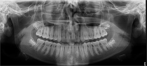 Figure 2 Sample of a dental panoramic radiograph of a 14-year-old boy.