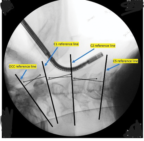Figure 2. Lateral fluoroscopic cervical X-ray image during intubation with videostylet.