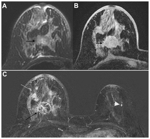 Figure 1 48-year-old woman with BI-RADS 6 lesions in the right breast detected on XR mammography and ultrasound (triple negative, IDC).