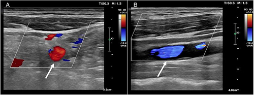 Figure 2 (A) The proximal lumen of the left internal jugular vein exhibits a rich blood flow signal (white arrow). (B) The middle and distal segments of the same vein display weak echogenicity with an absence of notable blood flow signals (white arrow).