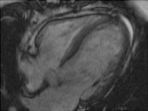 Figure 4 Cardiac MRI of a 34-year-old female half-marathon runner with recurrent pericarditis at the time of admission to our hospital.