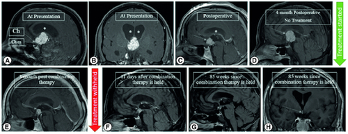 Figure 1. Preoperative and postoperative MRI imaging.Preoperative mid-sagittal (A) and coronal (B) postcontrast T1 WI showing a lobulated solid enhancing 3rd intraventricular mass, displacing the optic chiasm (Ch) downwards and forwards, bowing the floor of the third ventricle (3V) and sparing the pituitary stalk, infundibulum and the chiasmatic cistern (Ch cs), associated with subsequent obstructive hydrocephalus (asterisks). Serial mid-sagittal postcontrast T1 WI images (C) immediately following debulking of the 3rd intraventricular mass showing residual enhancing component (arrow) and resolution of the hydrocephalus (asterisks), (D) significant progression of the mass without treatment on the 4-month postoperative follow-up scan. Vemurafenib and cobimetinib combination therapy was started within 2 weeks and the 3-month post combination therapy shows significant reduction in the size of the residual mass (E). (F) 11-days after the treatment is held, the residual mass continues to shrink and show cavitary changes. Most recent mid-sagittal (G) and coronal (H) postcontrast T1 WI showing near complete resolution of the mass with a subcentimetric residual enhancing focus which remained stable for 1 year since it attained this size (85 weeks since treatment was withheld).