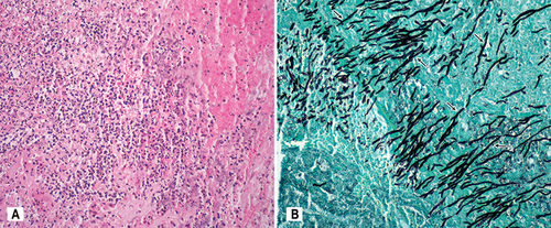Figure 2 Pathology of the external iliac artery fragment revealed focal necrosis and acute inflammation of the vascular wall caused by fungal arteritis: (A) hematoxylin and eosin staining, (B) lactophenol cotton blue staining with massive infestation by Aspergillus hyphae (black arrows).