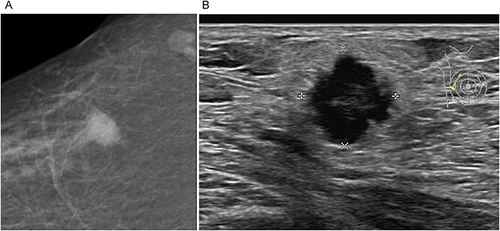 Figure 1 Image of a 65-year-old female patient in the PIMPC group. (A) The X-ray shows a high-density oval mass in the upper outer quadrant of the right breast with infiltrative margins and the burr sign. (B) The ultrasound shows a hypoechoic mass with uneven internal echoes and slightly reduced posterior echoes. The margin exhibits a crab claw-like pattern. The pathologic diagnosis was invasive micropapillary carcinoma of the right breast, 1.8 cm×1.5 cm×1.2 cm in size.