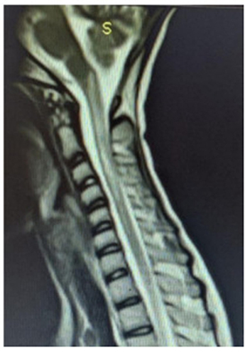 Figure 1 Cervical spinal MRI shows T2 hyperintense lesions of the cervical cord from foramen magnum to C7 level.