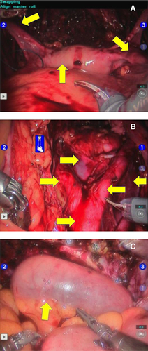 Figure 1 Steps of the operation. (A) Completed robot-assisted laparoscopic radical cystectomy with preservation of uterus and ovaries (arrows). (B) Appearance of extended pelvic lymph node dissection. Arrows: abdominal aorta and associated major vasculature. (C) Appearance of completed intracorporeal Studer pouch distended with sterile saline solution (arrow).