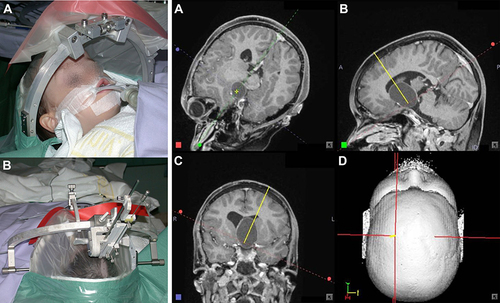 Figure 12 Stereotactic needle-based biopsy of large craniopharyngioma cyst in 11-year-old boy. (i) Operating room setup. (A) Anesthetized patient with stereotactic ring affixed to his head prior to the procedure. (B) Probe oriented towards the surgical entry point. (ii) (A–D) Surgical planning and navigation for biopsy. The procedure involves puncturing and draining the cyst, based on a visualization oriented according to the needle trajectory. Copyright © 2012. Reproduced from Trippel M, Nikkhah G. Stereotactic neurosurgical treatment options for craniopharyngioma. Front Endocrinol (Lausanne). 2012;3:63.61