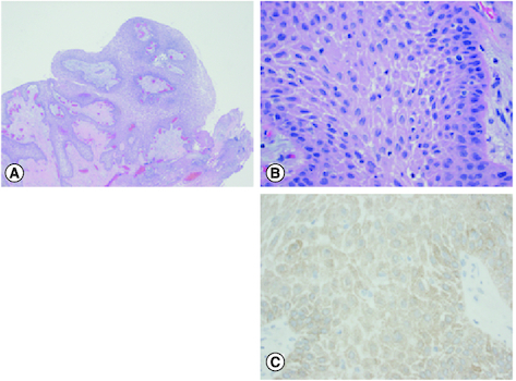Figure 2. Histopathological findings.Histopathology of the tumor, with H&E histology at 40× magnification (A), 400× magnification (B) and BRAF V600E immunohistochemistry at 400× magnification (C).An epithelium-lined mass with papillary configuration is noted (A) consisting of well-differentiated stratified squamous epithelium (B) overall similar to the appearance of a squamous papilloma, and in this anatomic location, characteristic of a papillary craniopharyngioma. Mutation specific immunohistochemistry for BRAF V600E was positive (C), also typical of papillary craniopharyngioma.