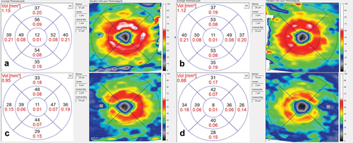 Figure 6. Optical coherence tomography macular ganglion cell analysis: (a) right eye at presentation; (b) left eye at presentation; (c) right eye at 2 months, following treatment and; (d) left eye at 2 months, following treatment.