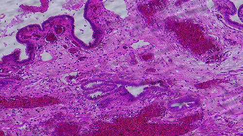 Figure 3 Histopathology showing chorionic villi and hemorrhagic vascular decidual tissue in the fallopian tube.