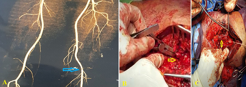 Figure 2 Computed tomography scan showing (A) partial laceration of superficial femoral artery (blue arrow), (B) Intraoperative image showing complete cutting of superficial femoral artery (yellow arrow); (C) Intraoperative image showing complete cutting of popliteal artery (yellow arrow).