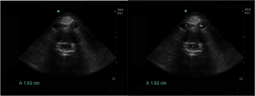 Figure 5 Axial ultrasound image of the abdominal aorta with inappropriate depth on the monitor where the spinal canal (*) is visualized on the center of the screen.
