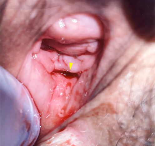 Figure 4 Gynecological examination showed rectovaginal fistula (arrowhead) on the dorsal aspect of the vagina at 1.0–1.5 cm from the vulva, with a size of 1.0 cm.