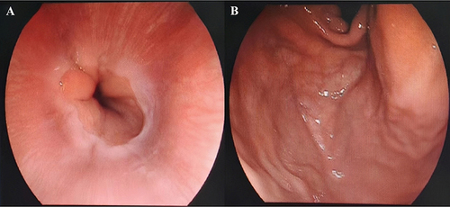 Figure 2 Upper gastrointestinal endoscopic images. There were no varices in the esophagus (A) or gastric fundus (B).
