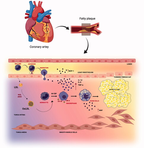 Figure 1. Steps in atherosclerosis initiation and progression: Atherosclerosis is characterized by a yellow color lesion formation. LDL gets converted to Ox-LDL after reaction with reactive oxygen species (ROS). Monocytes travel through leaky endothelium and differentiates into macrophages. Macrophage assimilates the Ox-LDL to form foam cells. Calcification and monocyte recruitment cause smooth cell proliferation and forms a necrotic core.