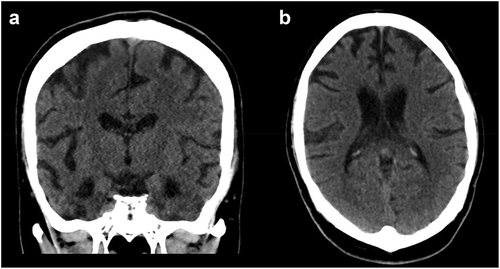 Figure 1. a. Coronal and b. Axial sections of head CT at initial Emergency Department visit in September 2019, 3 months after onset of symptoms.) .