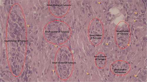 Figure 4 Histopathological examination with region of dominant cancer cells (marked in red oval circle) and lymphocytes marked by yellow arrows. There was only mild true tumour infiltrating lymphocyte. Examination was done in 100x magnification.