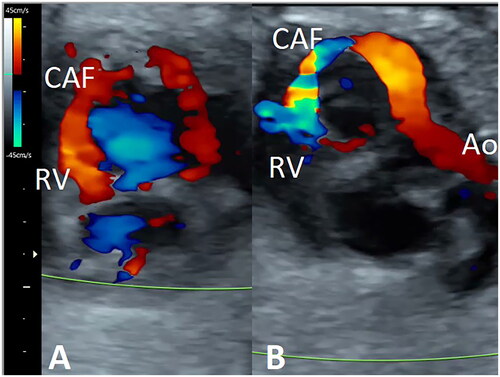 Figure 1. Short-axis view of the fetal heart. Color Doppler shows the presence of a fistulous tract arising from the right coronary artery, running through the posterior atrio-ventricular groove and draining into the right ventricle (RV). The filling of the fistulous tract is antegrade during ventricular diastole (A) and reversed during systole (B). Ao: aorta; CAF: coronary artery fistula.