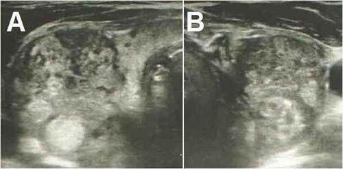 Figure 1. Thyroid ultrasonography shows increased dimensions of the gland and heterogeneous echotexture, with poorly defined regions of decreased echogenicity and pseudonodules consistent with thyroiditis. There are also multiple hyperechoic nodules in both the right (a) and the left (b) sides.