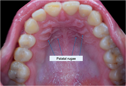 Figure 4 Sample picture of palatal rugae (Adapted from Shaimaa Abdellatif, CC BY-SA 4.0, via Wikimedia Commons; available from: https://commons.wikimedia.org/wiki/File:Rugae_area.jpg#file).