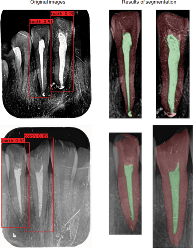 Figure 5. Result of root canal image segmentation.