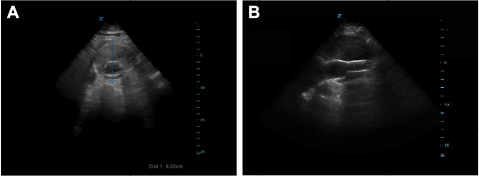 Figure 1 (A) Axial and (B) sagittal ultrasound images of a 6 cm abdominal aortic aneurysm with endovascular stent.