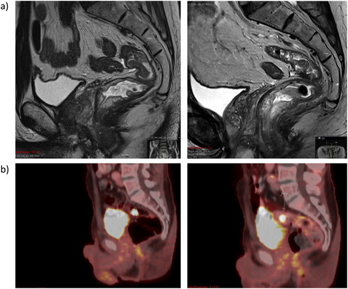 Figure 1. Case 1. a) MRI pre-treatment (left) and post-treatment (right). b) PET-CT scans after 3 months of treatment (left) and post-treatment (right). The polyp located near the malignant tumor remains unaffected by treatment.