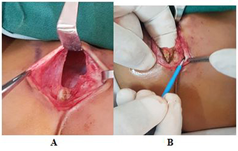 Figure 3 Intraoperative: (A) vertical incision was made, followed by raising skin flap; (B) exposing sternal bars and pectoralis major muscle flaps. The two halves were freed of underlying pleura and pericardium.
