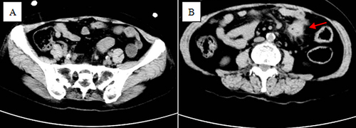 Figure 1 (A) The terminal ileum shows no obvious occupancy. (B) Preoperative CT image showing the morphology of the end of the descending colon–sigmoid colon–rectum intestinal tube thickening with multifocal areas of exudation and small lymph nodes. There were slightly hyperdense foci in the terminal sigmoido-rectal mesentery of the descending colon.(The descending colon tumour is indicated by the red arrow in the figure).