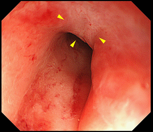 Figure 6 Colonoscopy showed improvement of colonic mucosal inflammation (Mayo endoscopic subscore 1). An ulcer near the dentate line was scarred (arrowheads).