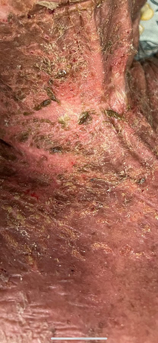 Figure 1 Detached skin around the neck and chest area.