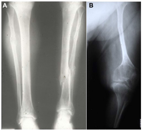 Figure 1 (A, B) Radiologic demonstration of marked differences in phenotype: OI types I and III.