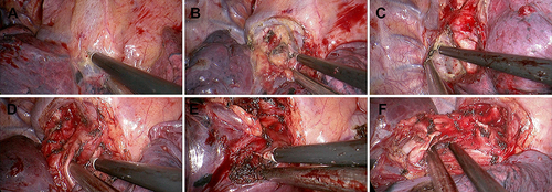 Figure 4 Coaxial manipulation of instruments during UVATS. (A) Dissection at the pulmonary hilum for clear access. (B) Lymphadenectomy of the 10th nodal station. (C) Lymphadenectomy of the 7th nodal station. (D) Mobilization of the right upper lobe’s arterial branch to secure vascular control. (E) Mobilization of the right upper lobe bronchus for bronchial management. (F) Mobilization of the right upper lobe vein for venous control.