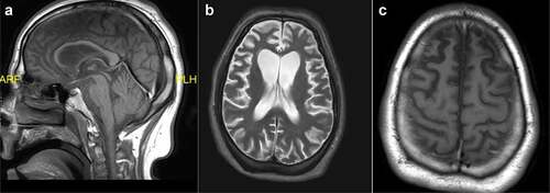 Figure 3. Head MRI during hospitalization in May 2020, 11 months after initial symptom onset. a. Sagittal T1-weighted midline image. b. Axial T2-weighted image. c. Axial T1-weighted image.