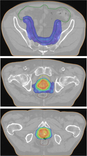 Figure 1. Original nominal treatment plan for one of the included patients. Transversal views at the level of the lymph nodes (top), seminal vesicles (Middle) and prostate (bottom). dose shown in color wash with a lower limit of 53.2 Gy and an upper limit of 81.5 Gy. Primary target outlined in red, elective target in light red, rectum in brown, bladder in yellow, bowel bag in green. Markers within the prostate volume in red, blue and green.