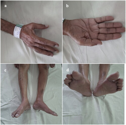 Figure 1. Wasting of small muscles of hand and legs. (a) Wasting of the first dorsal interossei. (b) Atrophy of the thenar and hypothenar eminences. (c) Thinning of legs. (d) Atrophy of the intrinsic foot muscles.