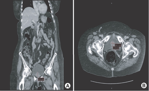 Figure 1. CT intravenous pyelogram (coronal and axial views) of polypoid urinary bladder mass. (A & B) CT intravenous pyelogram (coronal and axial views) showing polypoid soft tissue mass at the lower aspect of the urinary bladder measuring 3.3 × 3.1 × 2.4 cm compatible with the biopsy-proven malignant melanoma.