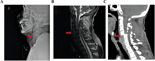 Figure 7 Radiographic examination of the patient with SCI. (A) Lateral radiographs, the arrow points to the 4/5 cervical dislocation. (B) Magnetic resonance imaging (MRI) in the sagittal position, the arrow points to injured cervical spinal cord. (C) Computed tomography (CT) in the sagittal position, the arrow points to the 4/5 cervical dislocation.