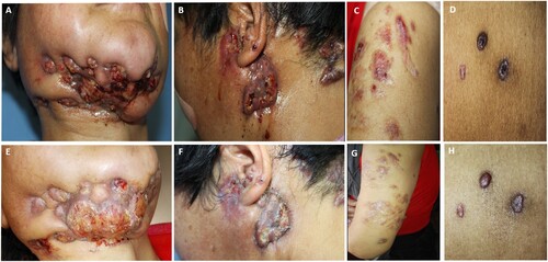 Figure 1. Clinical manifestations of the patient. A, B, C, D. Initial lesion; E, F, G, H. after six months of treatment. Red nodules and plaque with a clear boundary on the mandible, neck, extremities and trunk, with some ulcers and pus on the surface.