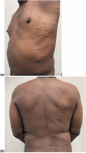 Figure 1. (a) Pityriasis rosea (chest, flank, and axilla); (b) pityriasis rosea (back).