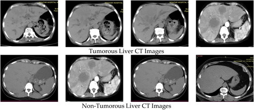 Figure 1. Tumorous and non-tumorous liver CT images dataset.