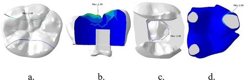 Figure 6 Stress distribution of interface between enamel-packable composite and dentin-fiber e-glass wallpapering the cavity floor after vertical loading on lower first molar with MOD cavity+ e-glass fiber reinforced composite: (a) occlusal of the tooth, (b) buccal of packable composite, (c) occlusal of fiber, and (d) e-glass fiber wallpapering the cavity floor.
