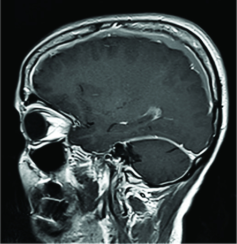 Figure 2. In the sagittal section of T1-weighted MRI with gadolinium enhancement showed diffuse pachymeningeal enhancement of the dura mater in the posterior fossa surrounding the cerebellum.