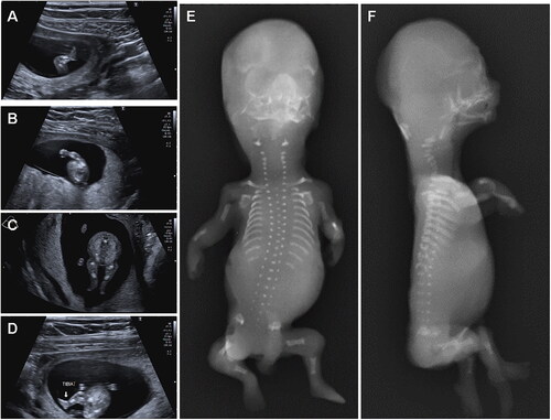 Figure 3. Instrumental examination at the second pregnancy. Ultrasounds at 12 + 1 weeks (A, B, C, D) show: mesomelic and rhizomelic shortening of both upper and lower limbs; redundant subcutaneous tissue of the limbs; small hands without polydactyly. X-rays after abortion (E, F) show shortened, but not bowed, long bones of the limbs, short ribs, absence of the 12th pair of ribs, small vertebral bodies with platyspondyly, reduced mineralization of the cervical vertebral bodies.