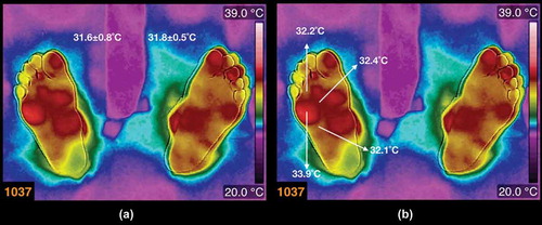 Figure 4. (a) Thermogram from a diabetic patient (the average temperatures are written above each foot). The patient is a female, 48 years old, BMI 38.7 kg/m2, 12 years with diagnosis of diabetes mellitus. (b) The arrows show the temperatures on the hot spot and some samples of the temperatures surrounding the hot spot.