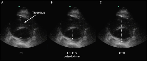 Figure 2 Axial ultrasound image of an abdominal aortic aneurysm with thrombus, demonstrating the three common methods to measure the aorta AP diameter.